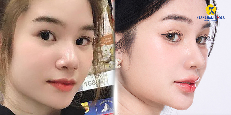 S-Line Rhinoplasty Cost 2026: The Complete Guide to Korean Nose Job Prices In Vietnam 3 S-Line Rhinoplasty Cost 2026