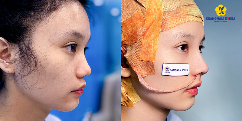 Surgical vs Non-Surgical Rhinoplasty Cost in Vietnam 2026 2 Surgical vs Non-Surgical Rhinoplasty Cost in Vietnam 2026