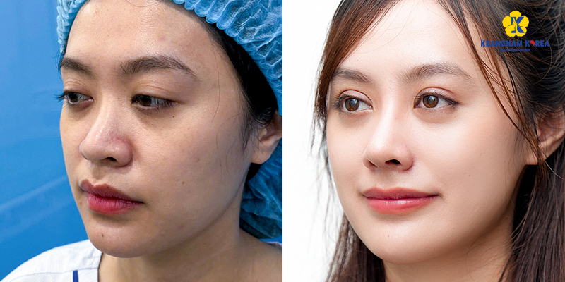 Surgical vs Non-Surgical Rhinoplasty Cost in Vietnam 2026 4 Surgical vs Non-Surgical Rhinoplasty Cost in Vietnam 2026