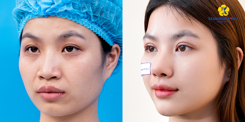 Surgical vs Non-Surgical Rhinoplasty Cost in Vietnam 2026 5 Surgical vs Non-Surgical Rhinoplasty Cost in Vietnam 2026