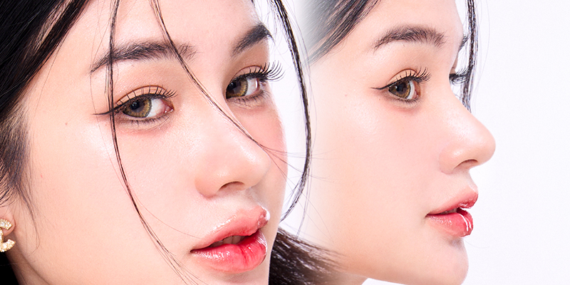 Surgical vs Non-Surgical Rhinoplasty Cost in Vietnam 2026 1 Surgical vs Non-Surgical Rhinoplasty Cost in Vietnam 2026