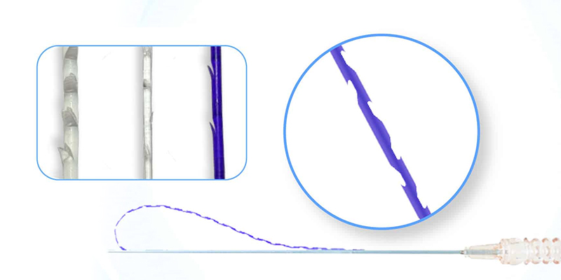 Thread Lift Cost by Type In Vietnam: 2026 Prices & Thread Types Comparison 2 Thread Lift Cost