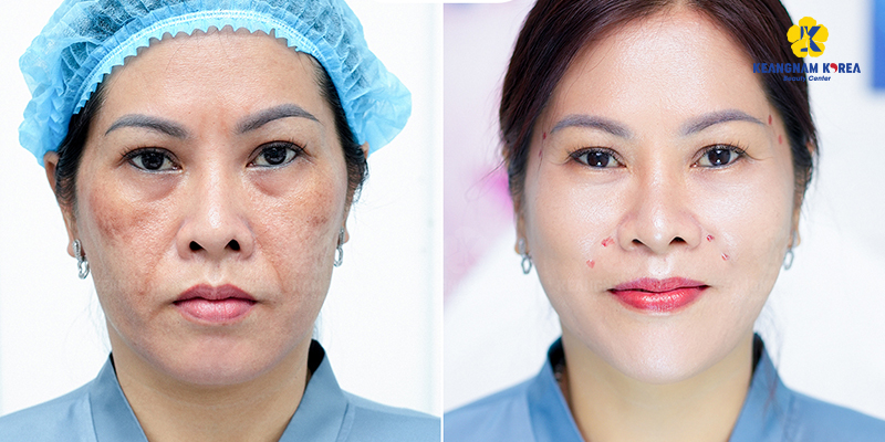 Thread Lift Cost by Type In Vietnam: 2026 Prices & Thread Types Comparison 4 Thread Lift Cost