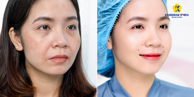 Thread Lift Cost by Type In Vietnam: 2026 Prices & Thread Types Comparison 5 Thread Lift Cost