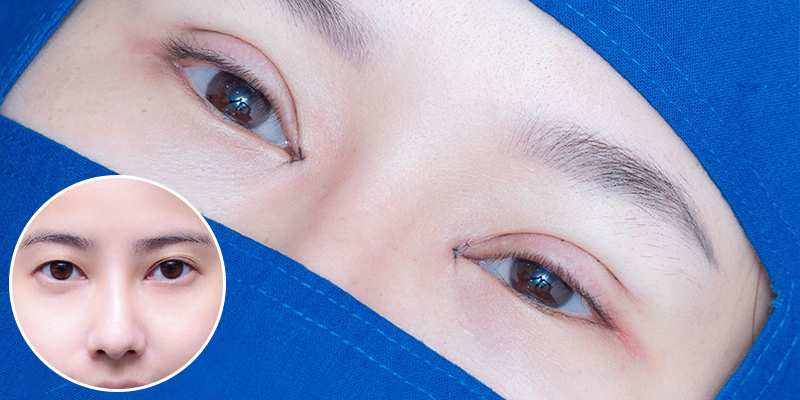 Upper Blepharoplasty Cost in 2026: Upper Eyelid Surgery Price List and Clinic in Vietnam 3 Upper Blepharoplasty Cost in 2026