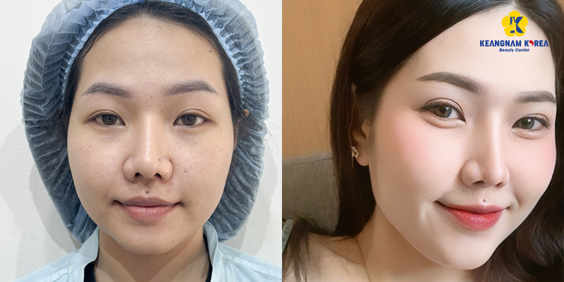 Upper Blepharoplasty Cost in 2026: Upper Eyelid Surgery Price List and Clinic in Vietnam 4 Upper Blepharoplasty Cost in 2026