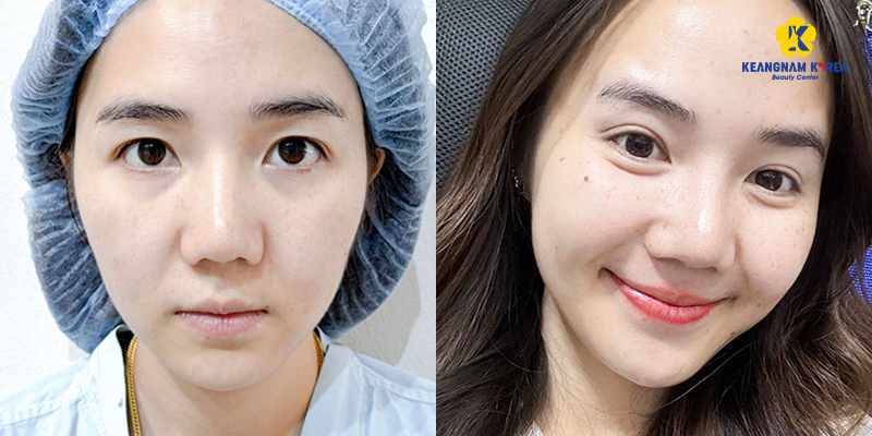 Upper Blepharoplasty Cost in 2026: Upper Eyelid Surgery Price List and Clinic in Vietnam 5 Upper Blepharoplasty Cost in 2026