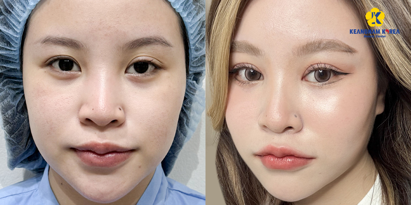 Upper Blepharoplasty Cost in 2026: Upper Eyelid Surgery Price List and Clinic in Vietnam 6 Upper Blepharoplasty Cost in 2026