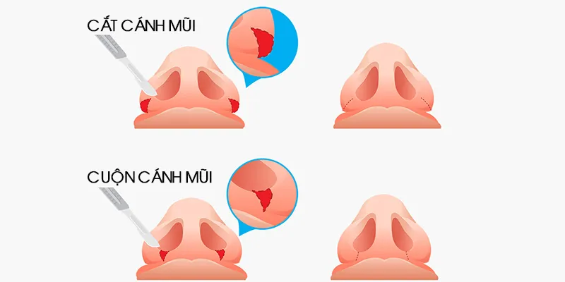 Thu gọn cánh mũi giá bao nhiêu?  