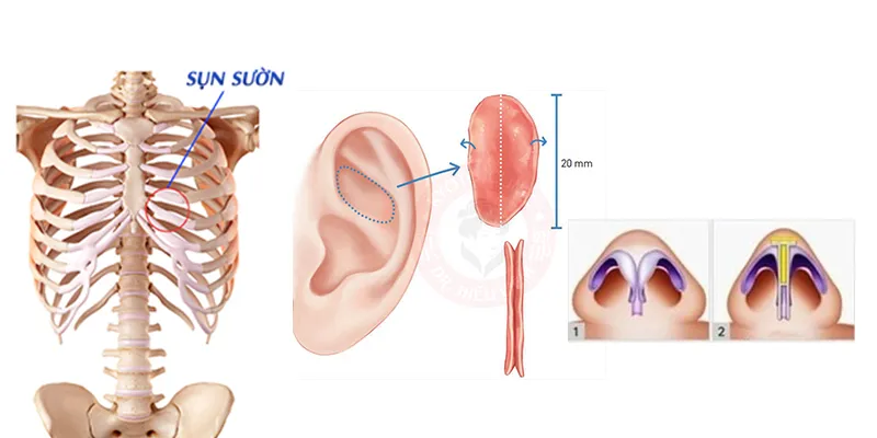 các loại sụn nâng mũi