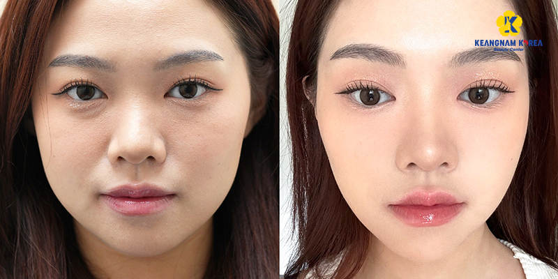Mesotherapy Cost in 2026: Price Guide by Skin Treatment Goal 2 mesotherapy cost ho chi minh 1