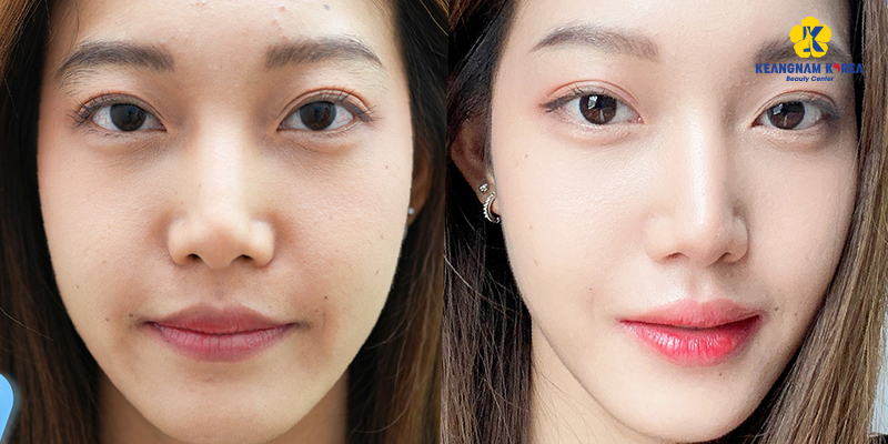 Mesotherapy Cost in 2026: Price Guide by Skin Treatment Goal 3 mesotherapy cost ho chi minh 2