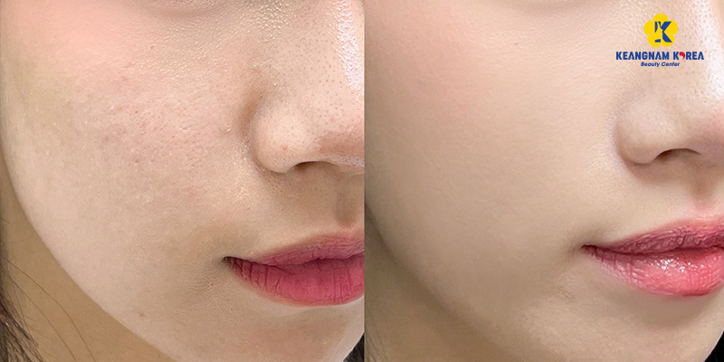 Mesotherapy Treatment: A Complete Guide to Healthy, Glowing Skin 6 Mesotherapy Cost in Vietnam, 2026