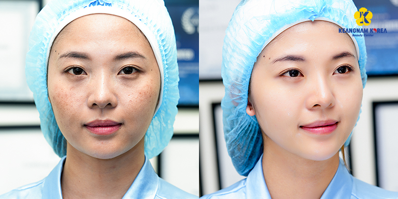 Mesotherapy Treatment: A Complete Guide to Healthy, Glowing Skin 3 What Can Mesotherapy Treatment Address?