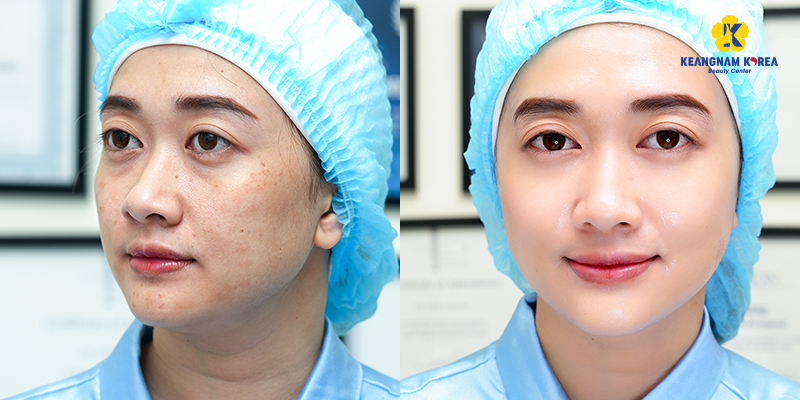 Mesotherapy Treatment: A Complete Guide to Healthy, Glowing Skin 4 What is The Best Type of Mesotherapy Treatment?