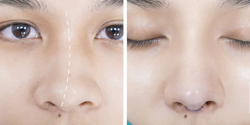 Septoplasty Cost in Vietnam 2026: A Complete Price Guide Before You Decide 2 Septoplasty Cost in Vietnam 2026