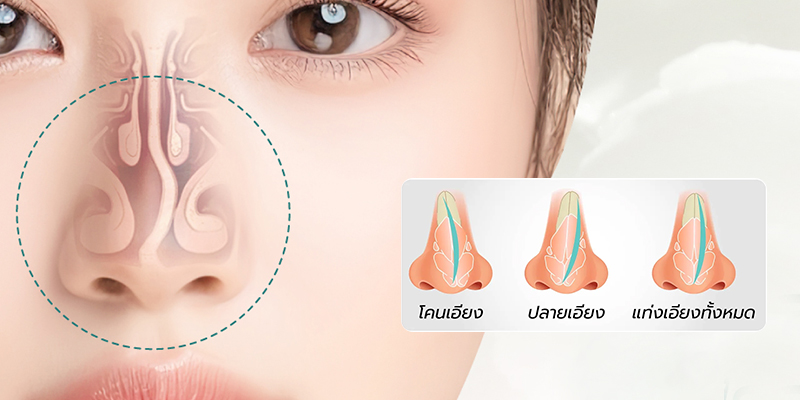 Septoplasty Cost in Vietnam 2026: A Complete Price Guide Before You Decide 1 Septoplasty Cost in Vietnam 2026