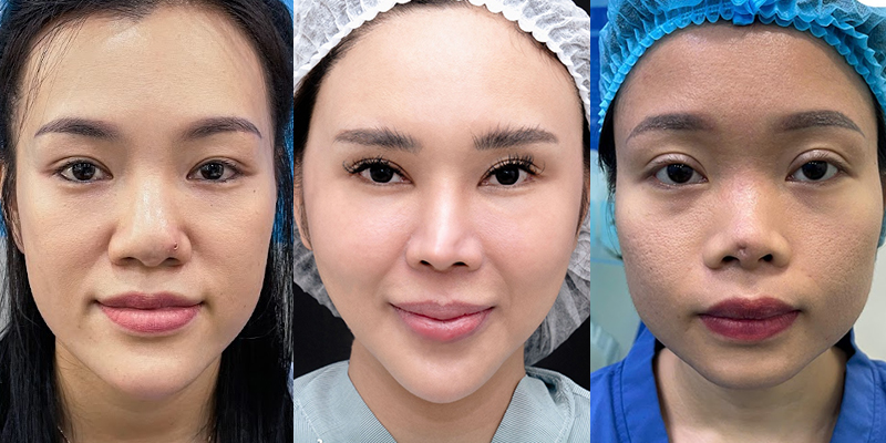 Tip Rhinoplasty Cost in Ho Chi Minh City, 2026 2 Tip Rhinoplasty Cost in Ho Chi Minh City, 2026