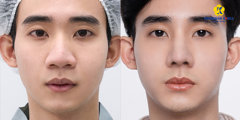 Tip Rhinoplasty Cost in Ho Chi Minh City, 2026 4 Tip Rhinoplasty Cost in Ho Chi Minh City, 2026