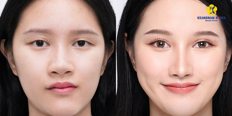 Tip Rhinoplasty Cost in Ho Chi Minh City, 2026 5 Tip Rhinoplasty Cost in Ho Chi Minh City, 2026