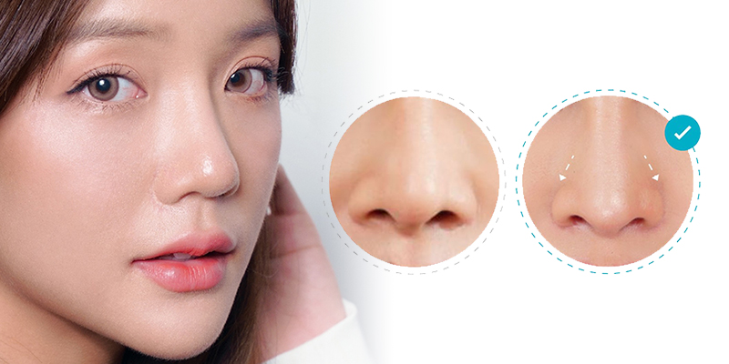 Tip Rhinoplasty Cost in Ho Chi Minh City, 2026 1 Tip Rhinoplasty Cost in Ho Chi Minh City, 2026