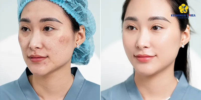 Cách trị nám da mặt hiệu quả
