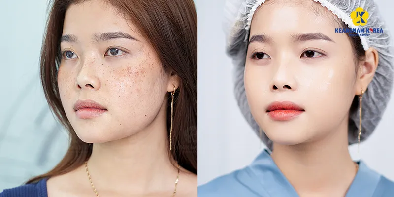 Cách trị nám da mặt hiệu quả
