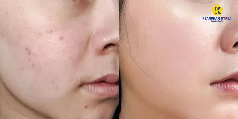 Làm cách nào thu nhỏ lỗ chân lông nhanh chóng? 