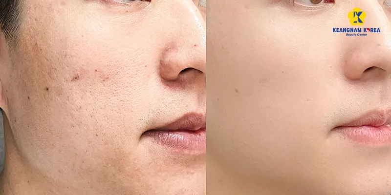 Thẩm mỹ thu nhỏ lỗ chân lông ở đâu tốt