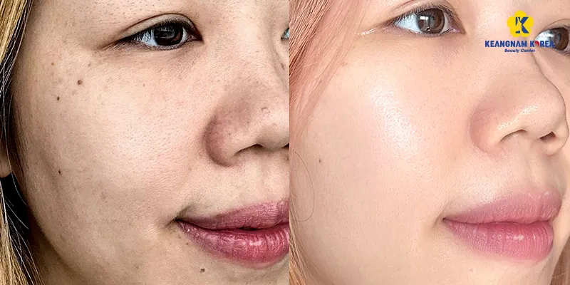 Thẩm mỹ thu nhỏ lỗ chân lông ở đâu tốt