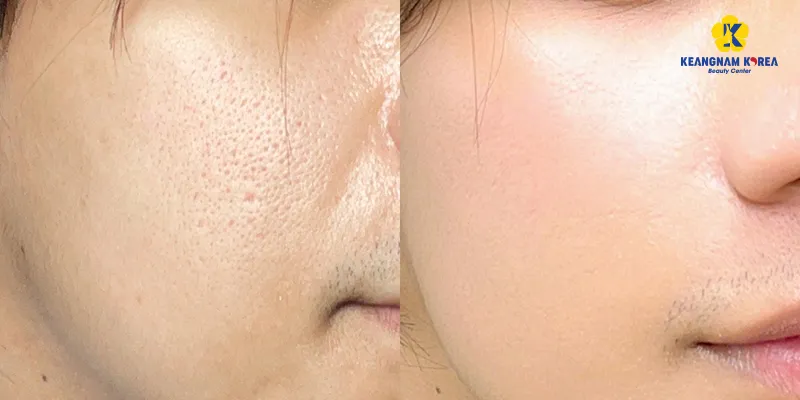 Thẩm mỹ thu nhỏ lỗ chân lông ở đâu tốt