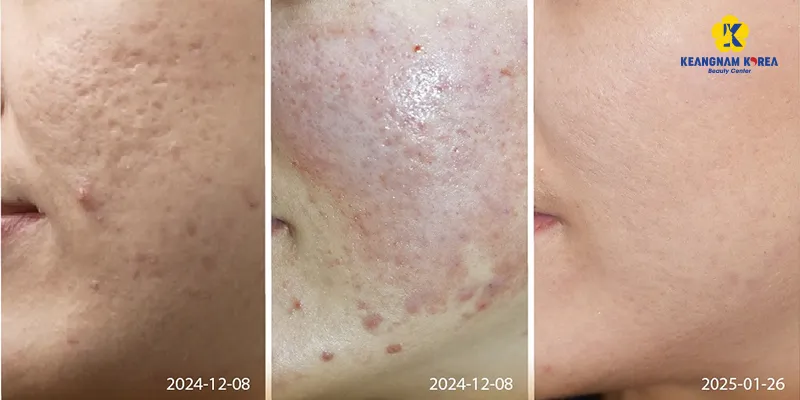 1 liệu trình trị sẹo rỗ tại Keangnam Korea giá bao nhiêu