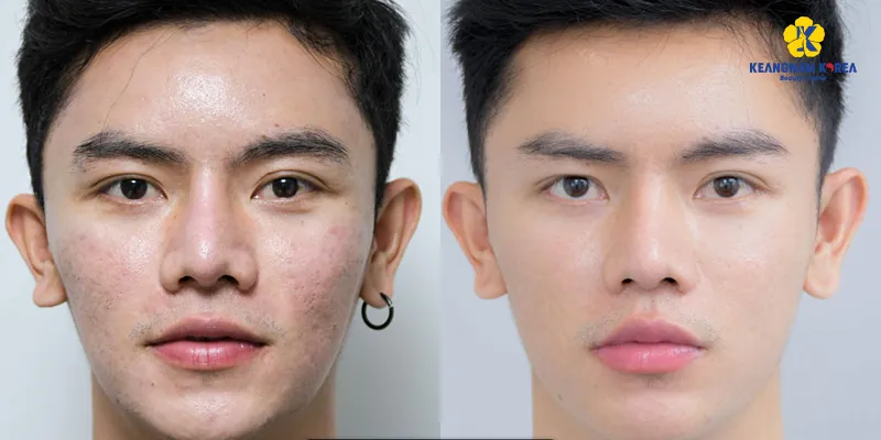 1 liệu trình trị sẹo rỗ tại Keangnam Korea giá bao nhiêu