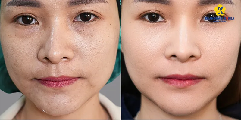 1 liệu trình trị sẹo rỗ tại Keangnam Korea giá bao nhiêu