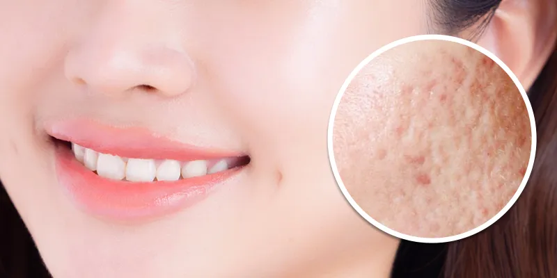 1 liệu trình trị sẹo rỗ tại Keangnam Korea giá bao nhiêu