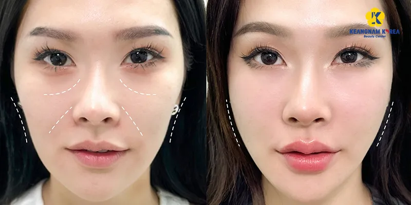 7 loại tinh chất meso hiệu quả nhất 