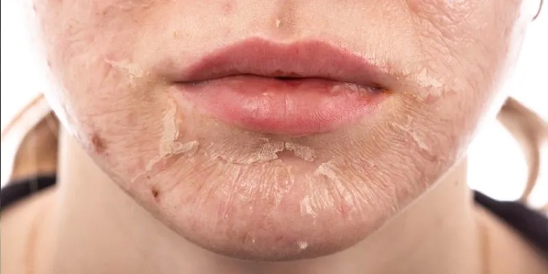 Lăn kim trị sẹo rỗ có hiệu quả không