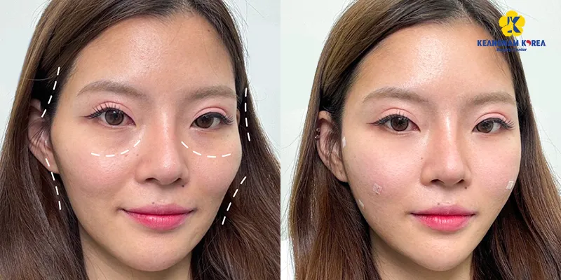 Meso trị thâm mắt có hiệu quả không?   