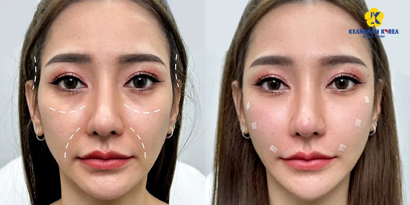 Meso trị thâm mắt có hiệu quả không?   