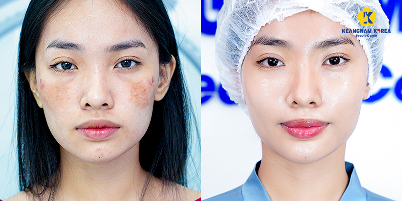 7 Best Mesotherapy Serums in Vietnam 2026 6 Best Mesotherapy Clinic