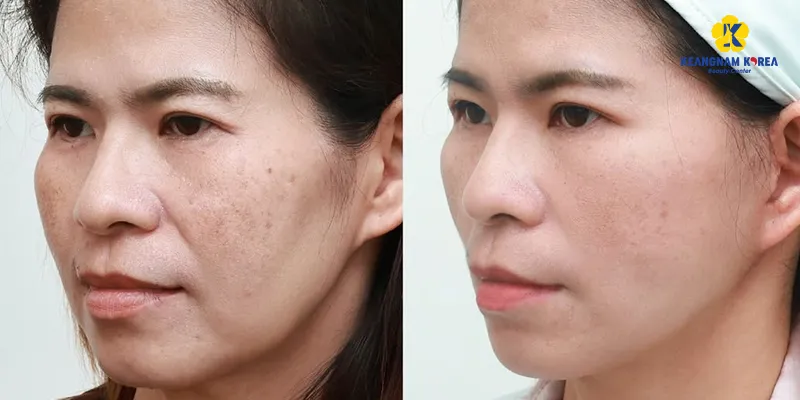 So sánh lăn kim và meso da, phương pháp nào phù hợp hơn?   