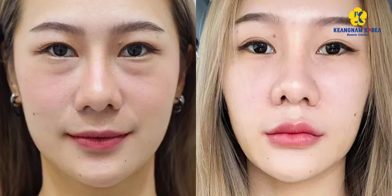 Nguyên nhân và cách làm mờ quầng thâm mắt hiệu quả nhanh