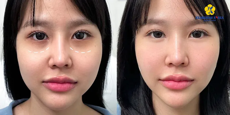 Nguyên nhân và cách làm mờ quầng thâm mắt hiệu quả nhanh