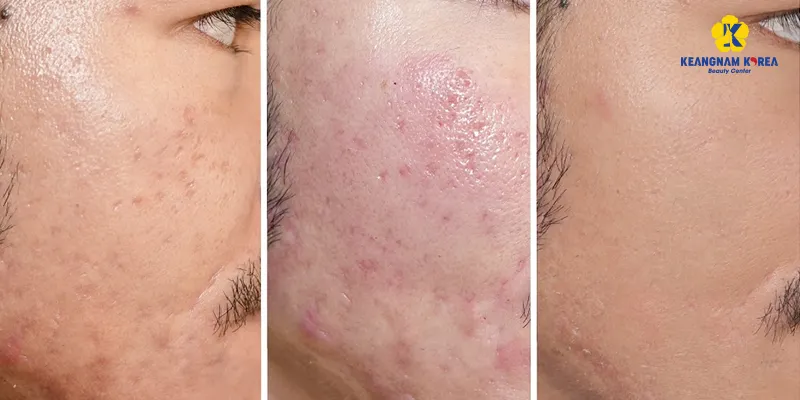 cách trị sẹo rỗ mới hình thành