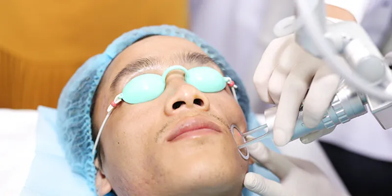 Cách trị sẹo rỗ trên mặt