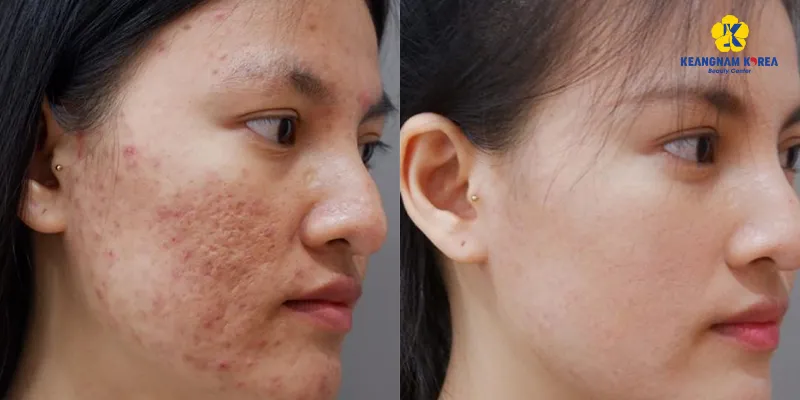 Cách trị sẹo rỗ trên mặt