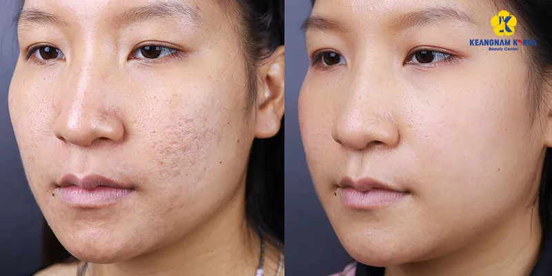 Cách trị sẹo rỗ trên mặt