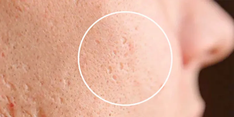 cách trị sẹo rỗ trên mặt