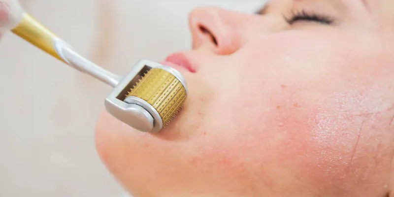 Cách chữa sẹo rỗ lâu năm