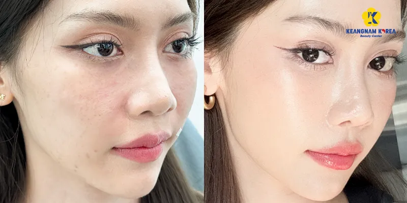 Công dụng của meso căng bóng da 